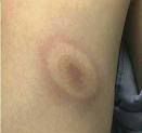 Tick bite with bull's eye rash